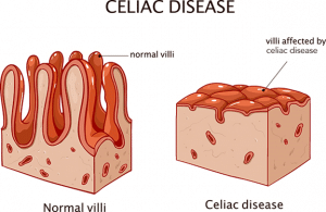 Celiac Disease is an autoimmune condition affecting gut health